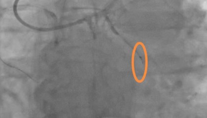 老人手术时导丝断裂掉进血管 医院：外科取出意义不大，补偿8000元