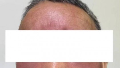 杭州发生多起！面部肿成“馒头”！6小时内处理很重要