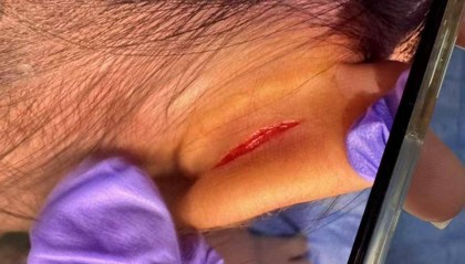 武汉一女童上高端托儿班耳朵疑被撕裂 家长：院方说监控坏了